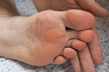 Lumps caused by calluses infection