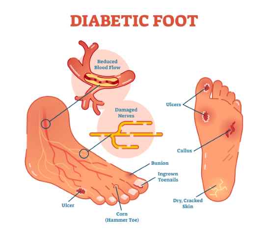 Identifying issues of a diabetic's foot
