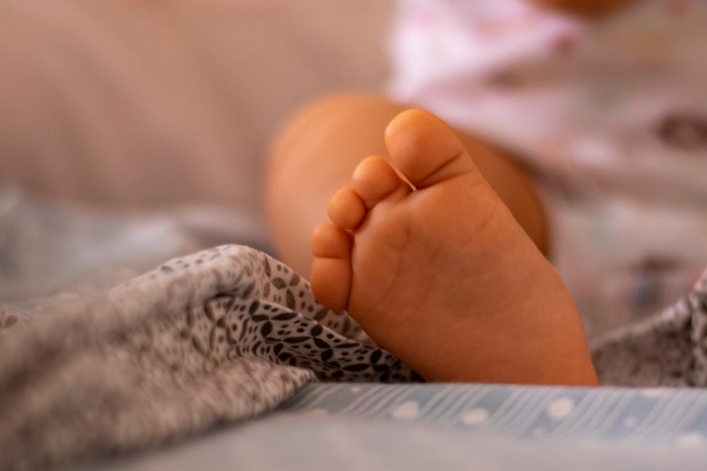 Treating Syndactyly of The Foot (bed Toes)