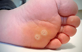 Visible Verrucas on the underside of a foot